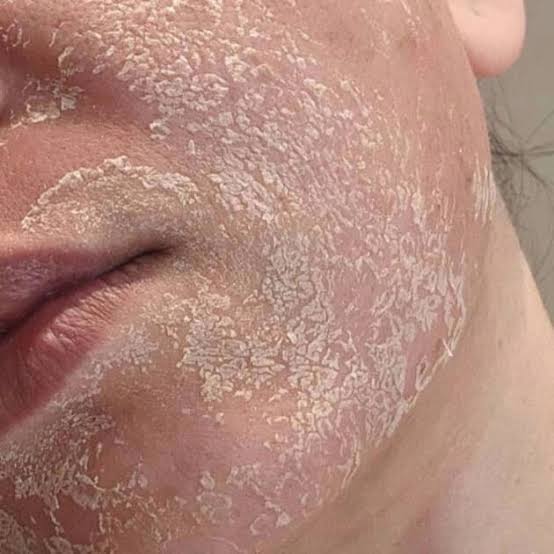 Peeling aux algues (rose de mer)
